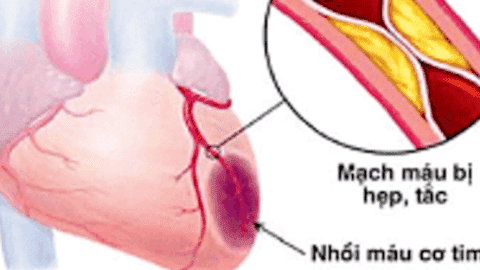 BỆNH TIM MẠCH - KẺ GIẾT NGƯỜI THẦM LẶNG
