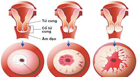 Những dấu hiệu cảnh báo ung thư cổ tử cung ở phụ nữ trẻ